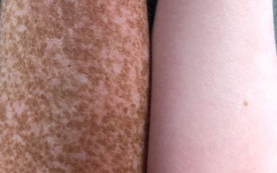 Rachel asked me why our skin is different. I don’t know the exact science behind freckles, so I opted for the, “Everyone has different types of skin.”
