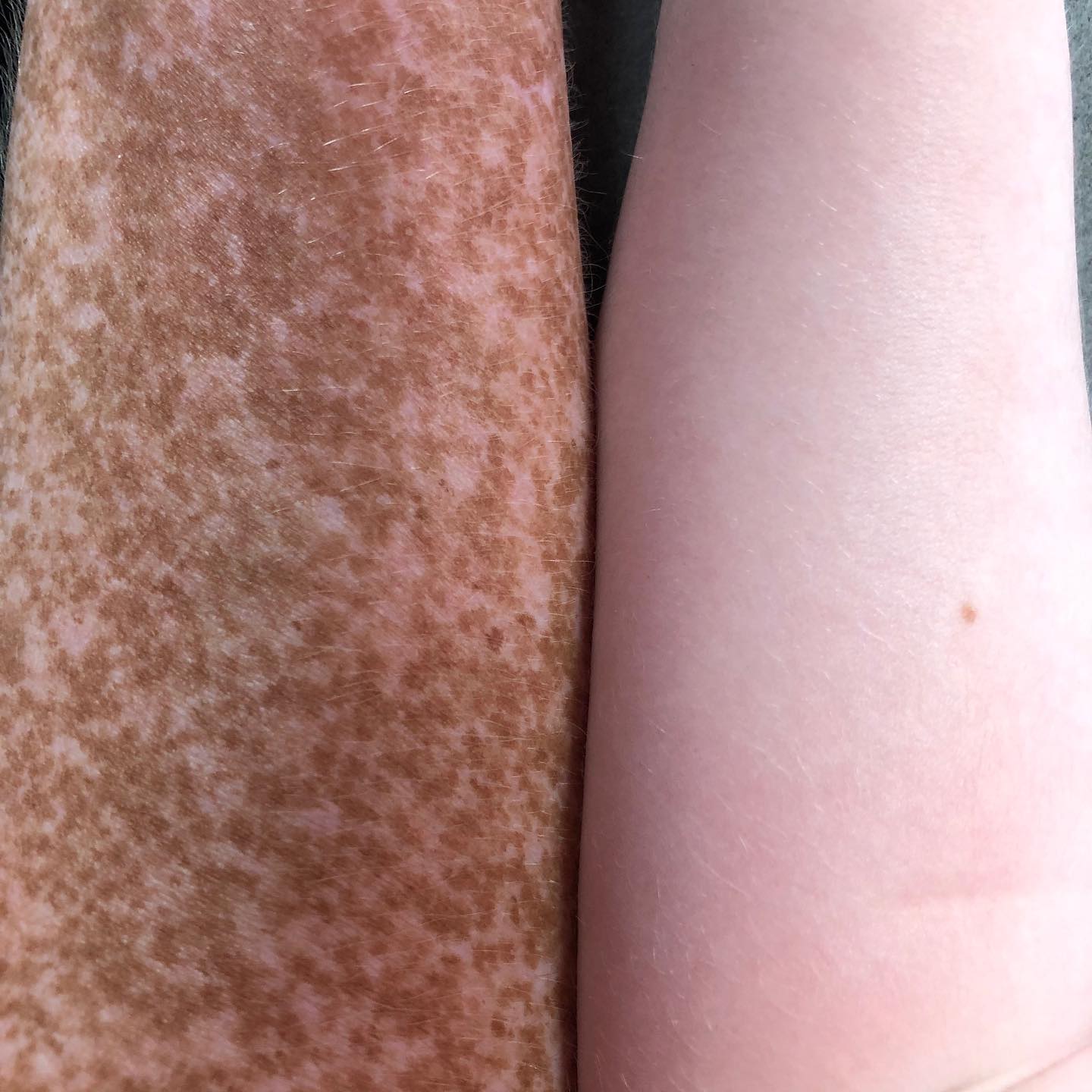 Rachel asked me why our skin is different. I don’t know the exact science behind freckles, so I opted for the, “Everyone has different types of skin.”